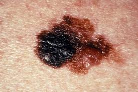 Melanom vychází z pigmentových buněk a primárně postihuje kůži.